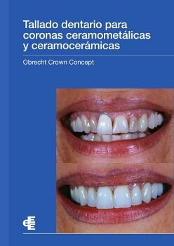 TALLADO DENTARIO PARA CORONAS CERAMOMETLICAS Y CERAMOCERMICAS