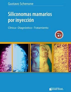 SILICONOMAS MAMARIOS POR INYECCION