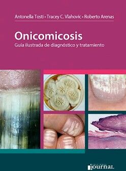 ONICOMICOSIS