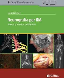 NEUROGRAFIA POR RM  -PLEXOS Y NERVIOS PERIFERICOS-